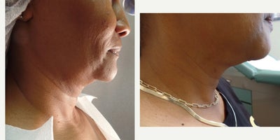 FaceTite before and after photo