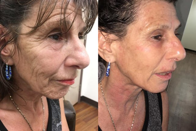 PRP Injections before and after photo