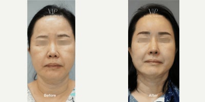 Asian Rhinoplasty before and after photo