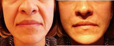 Radiesse before and after photo