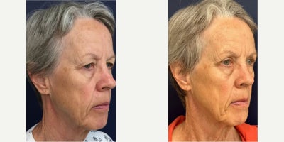 Eyelid Surgery before and after photo