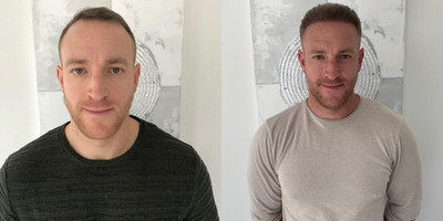 FUE Hair Transplant before and after photo