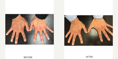 Hand Rejuvenation before and after photo
