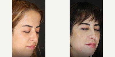 Canthoplasty before and after photo
