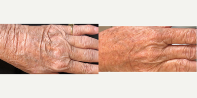 Hand Rejuvenation before and after photo