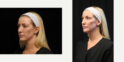 Juvederm before and after photo