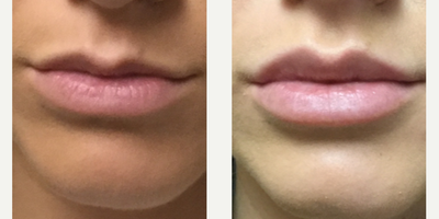 Juvederm before and after photo