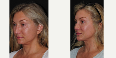 Chin Implant before and after photo