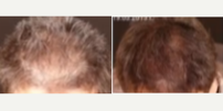 Microneedling before and after photo