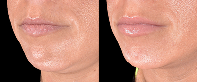 Restylane before and after photo