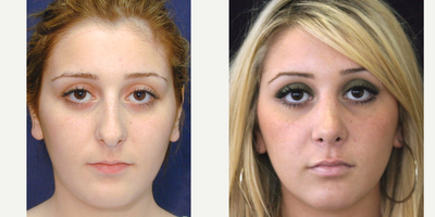 Rhinoplasty before and after photo