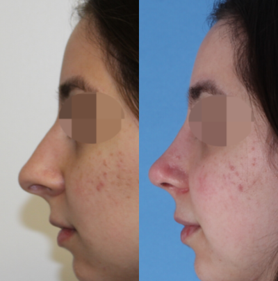 Rhinoplasty before and after photo