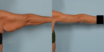 Arm Lift before and after photo