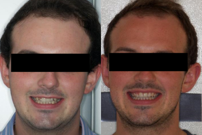 Braces before and after photo