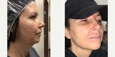 Chemical Peel before and after photo