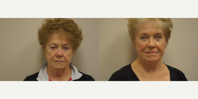 Facelift before and after photo