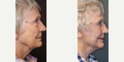 Fractional Laser before and after photo