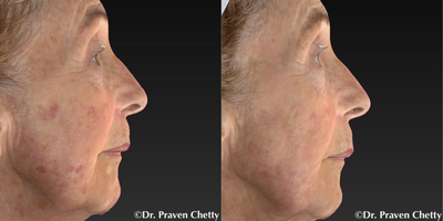 Laser Resurfacing before and after photo