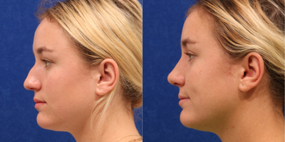 Rhinoplasty before and after photo