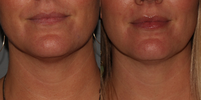 Vollure before and after photo