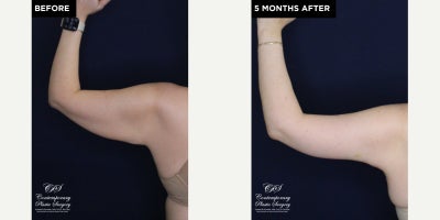 Arm Lift before and after photo
