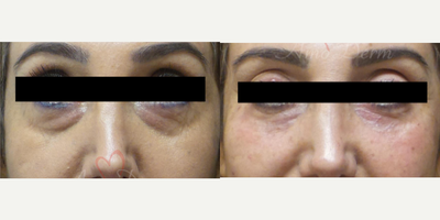 Eyelid Surgery before and after photo