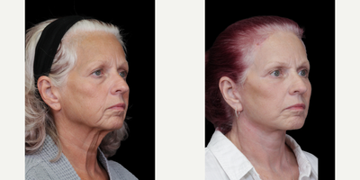 Eyelid Surgery before and after photo