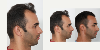 FUE Hair Transplant before and after photo