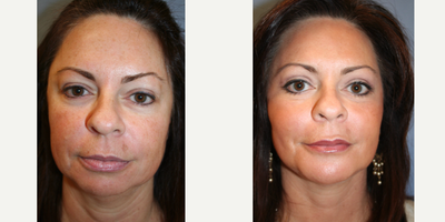Genioplasty before and after photo
