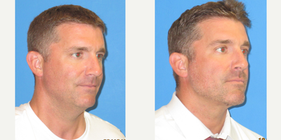 Neck Lift before and after photo