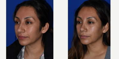 Rhinoplasty before and after photo