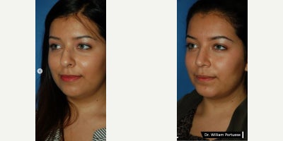 Rhinoplasty before and after photo