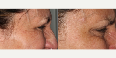 Botox before and after photo