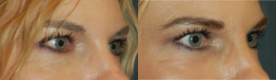 Chemical Peel before and after photo