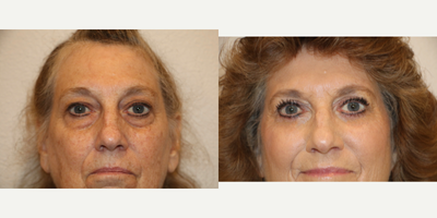 Eyelid Surgery before and after photo
