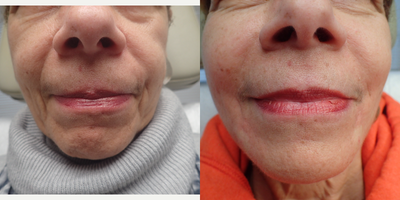 Restylane Lyft before and after photo