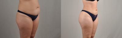 Laser Liposuction before and after photo