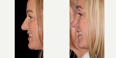 Rhinoplasty before and after photo