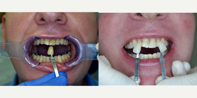 Teeth Whitening before and after photo