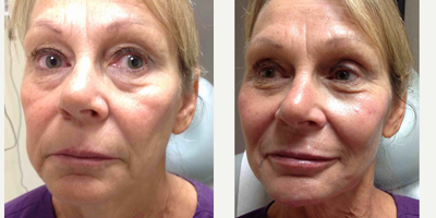 Voluma before and after photo