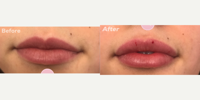 Lip Fillers before and after photo
