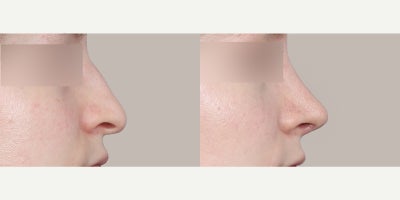 Rhinoplasty before and after photo
