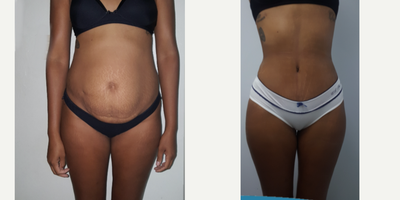 Tummy Tuck before and after photo