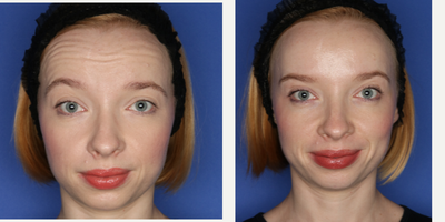 Xeomin before and after photo