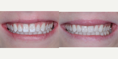 Dental Bonding before and after photo