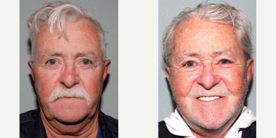 Facelift before and after photo