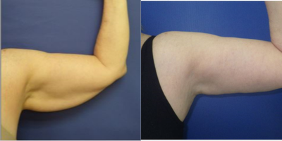 Arm Lift before and after photo
