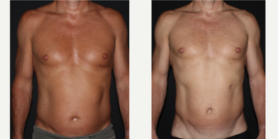 Lipoma Removal before and after photo