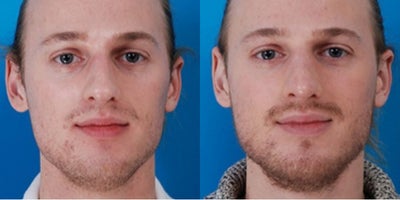 Rhinoplasty before and after photo