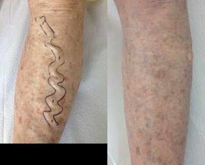 Sclerotherapy before and after photo